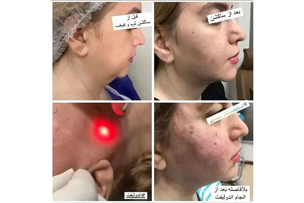 بهترین روش رفع غبغب | بررسی روش‌های بدون جراحی و با جراحی